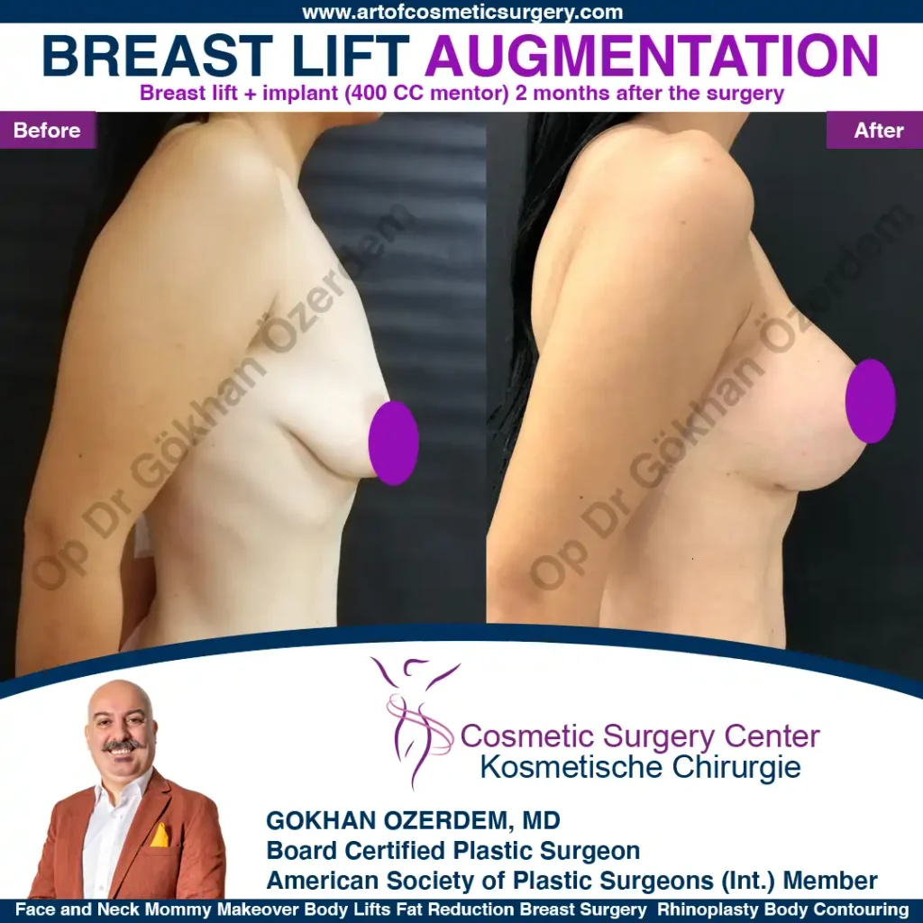 Breast Lift in Turkey, Case 4 - Right View - with implant