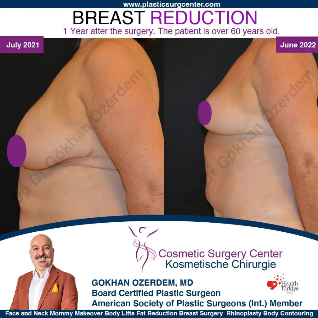 Breast Reduction in Turkey, Case 15 - Left Side