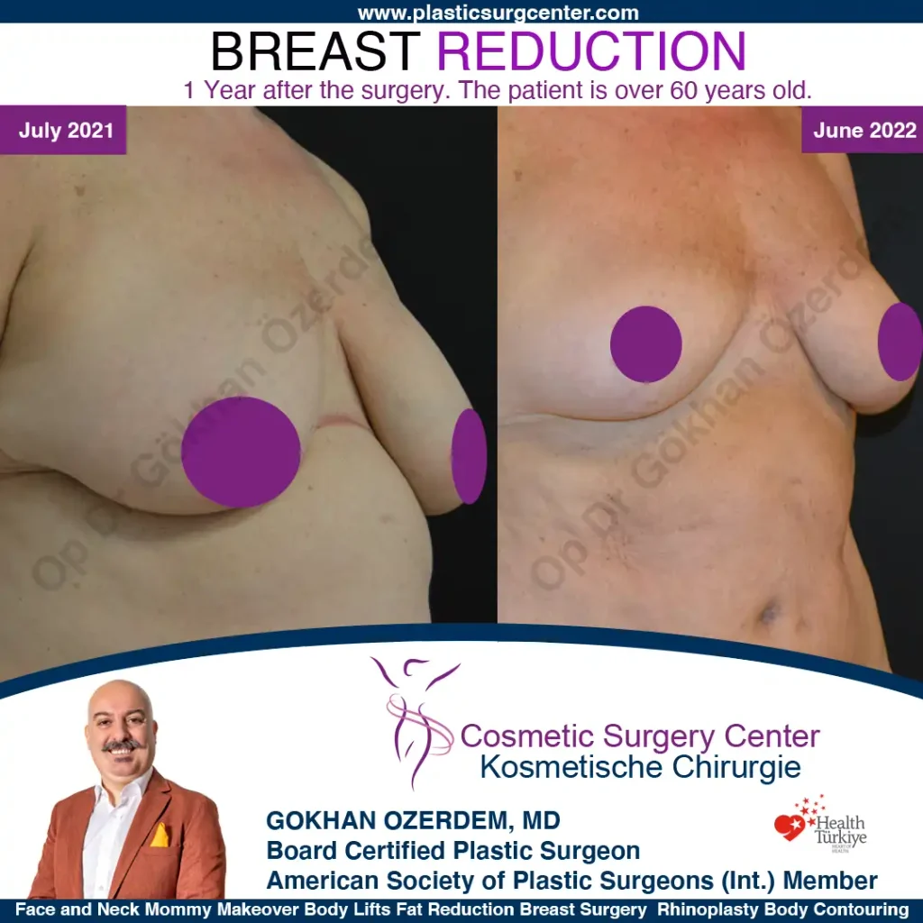 Breast Reduction in Turkey, Case 15 - Oblique Side