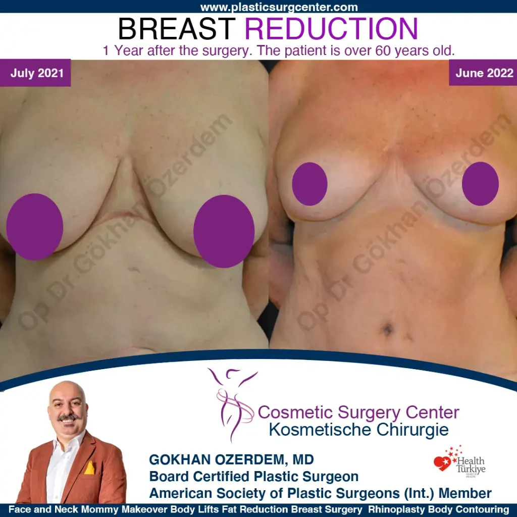 Breast Reduction in Turkey, Case 15 - Front Side