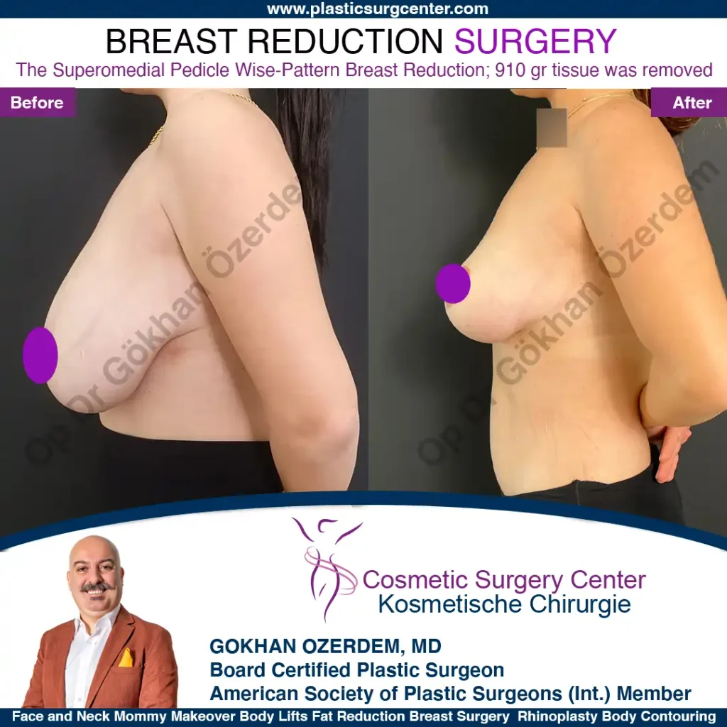 Breast Reduction in Turkey, Case 14 - Left Side