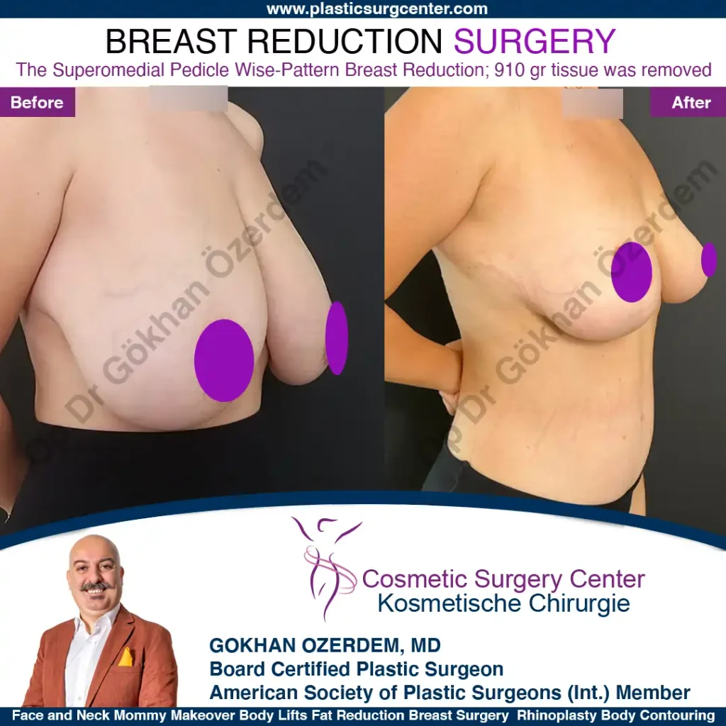 Breast Reduction in Turkey, Case 14 - Oblique View