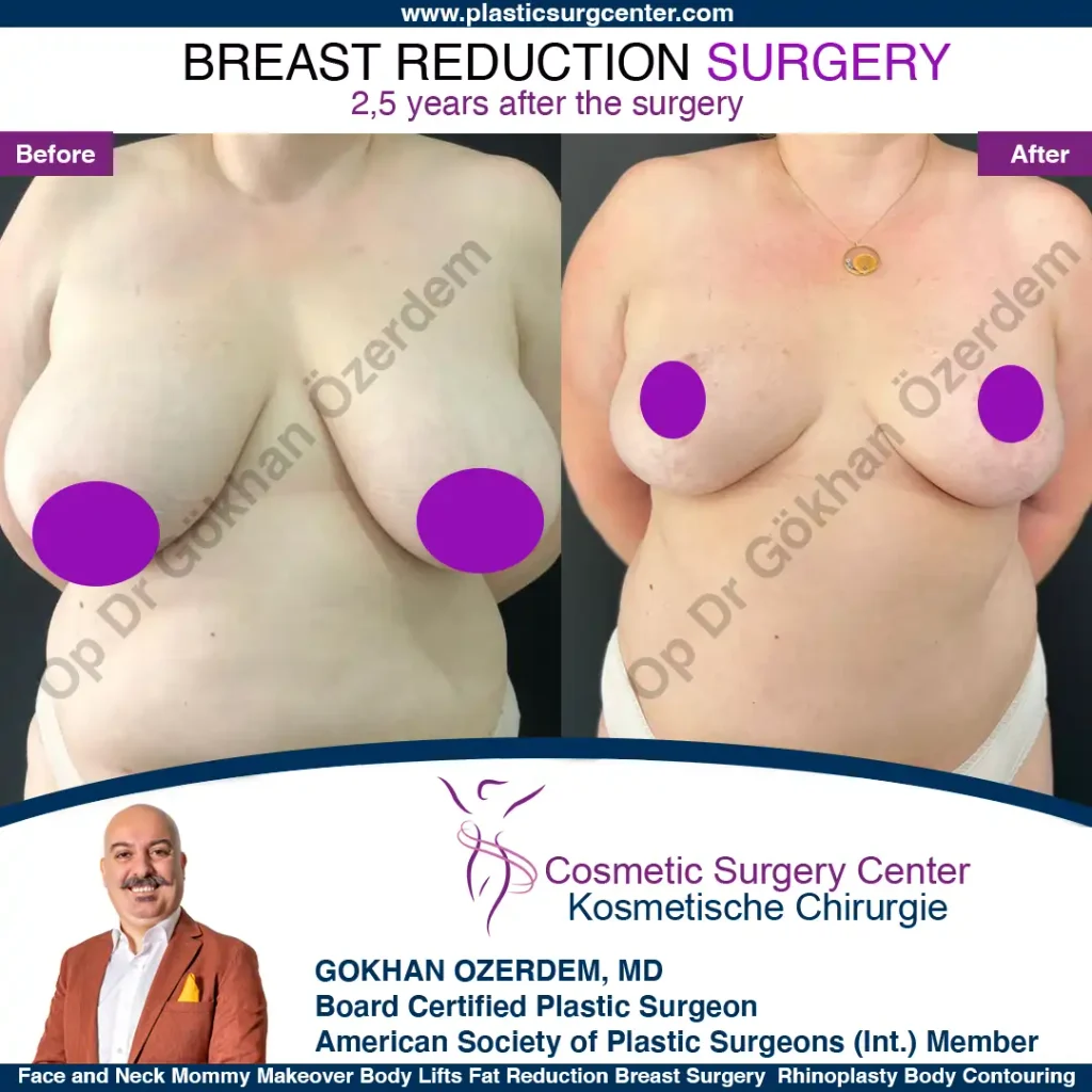 Breast Reduction in Turkey, Case 13 - Front View