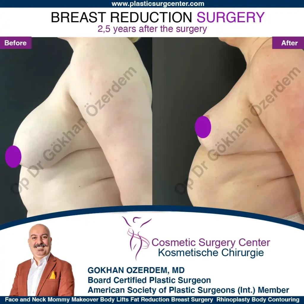 Breast Reduction in Turkey, Case 13 - Left Side