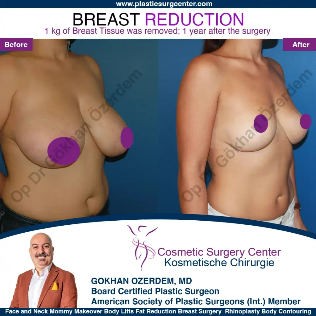 Breast Reduction in Turkey, Case 7 - Oblique View