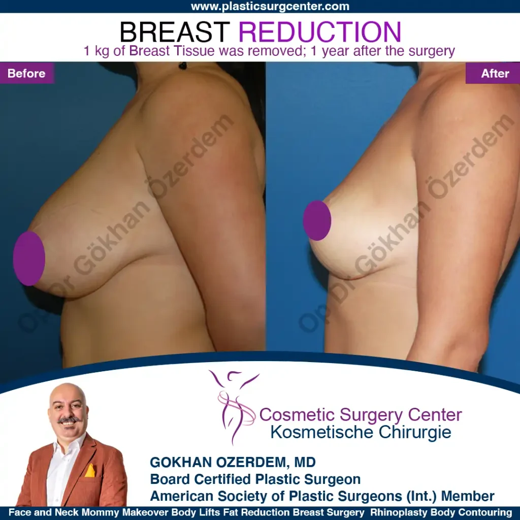 Breast Reduction in Turkey, Case 7 - Left Side