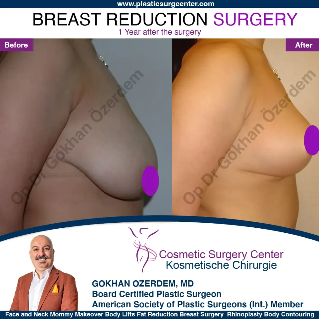 Breast Reduction in Turkey, Case 11 - Right Side