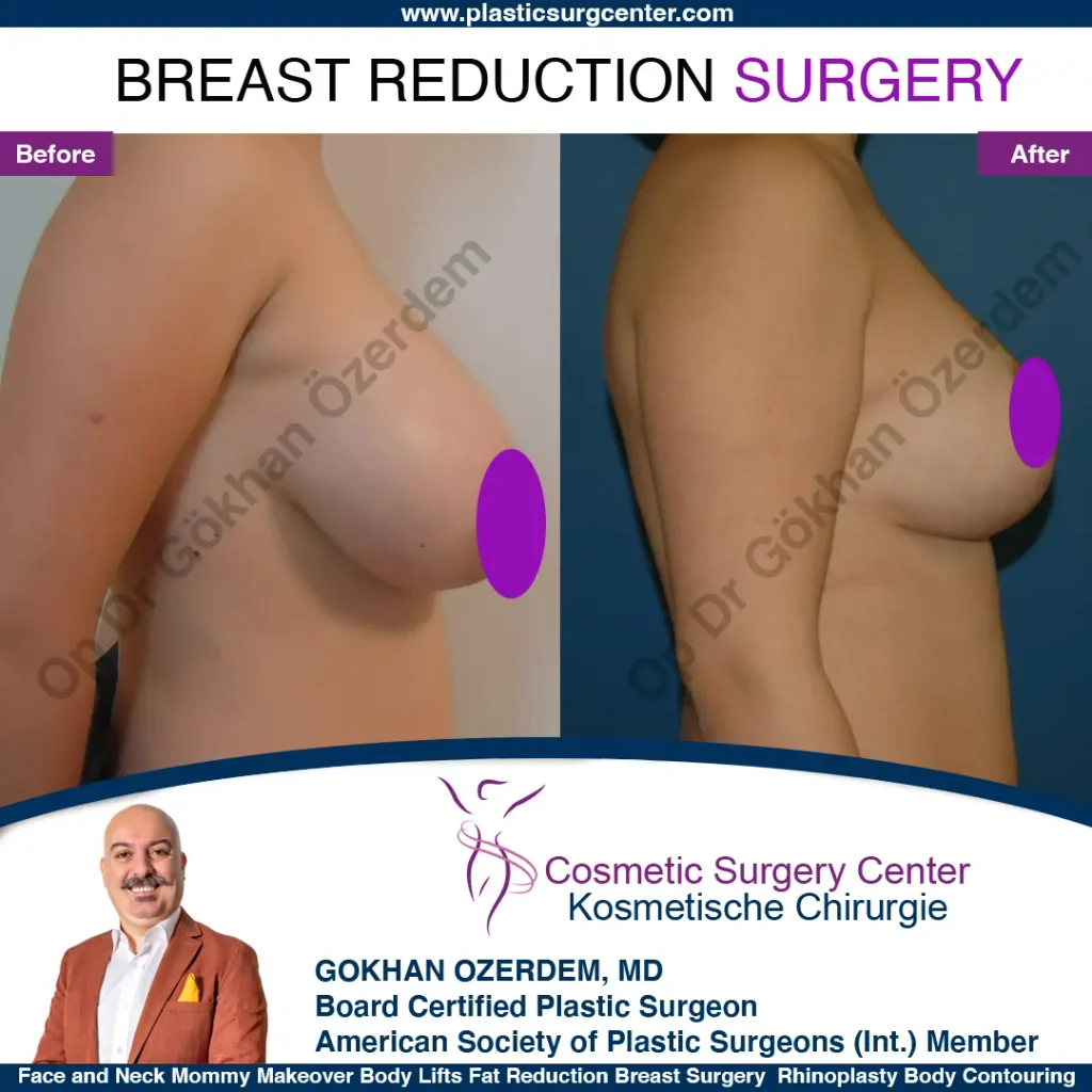 Breast Reduction in Turkey, Case 12 - Right Side