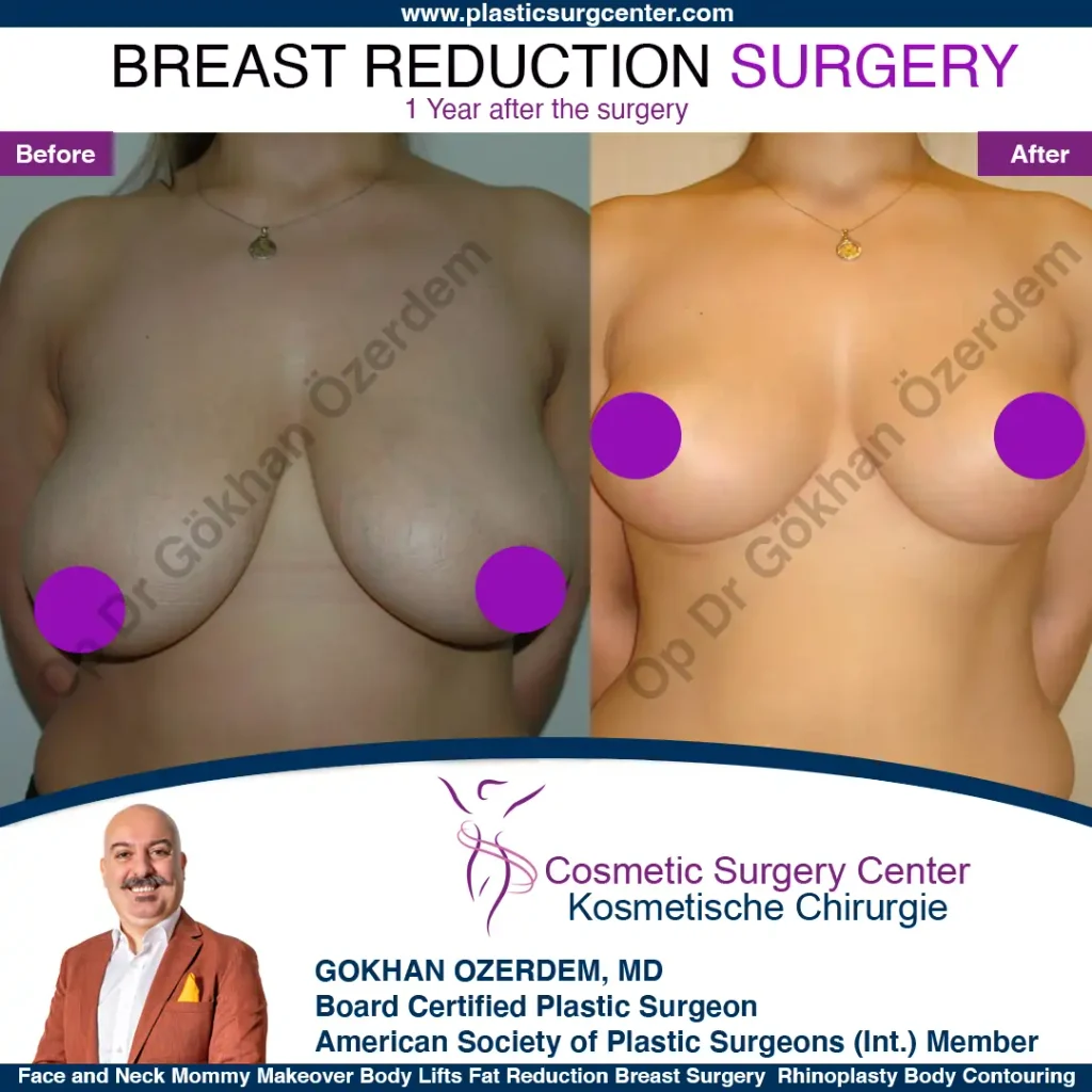 Breast Reduction in Turkey, Case 11 - Front View