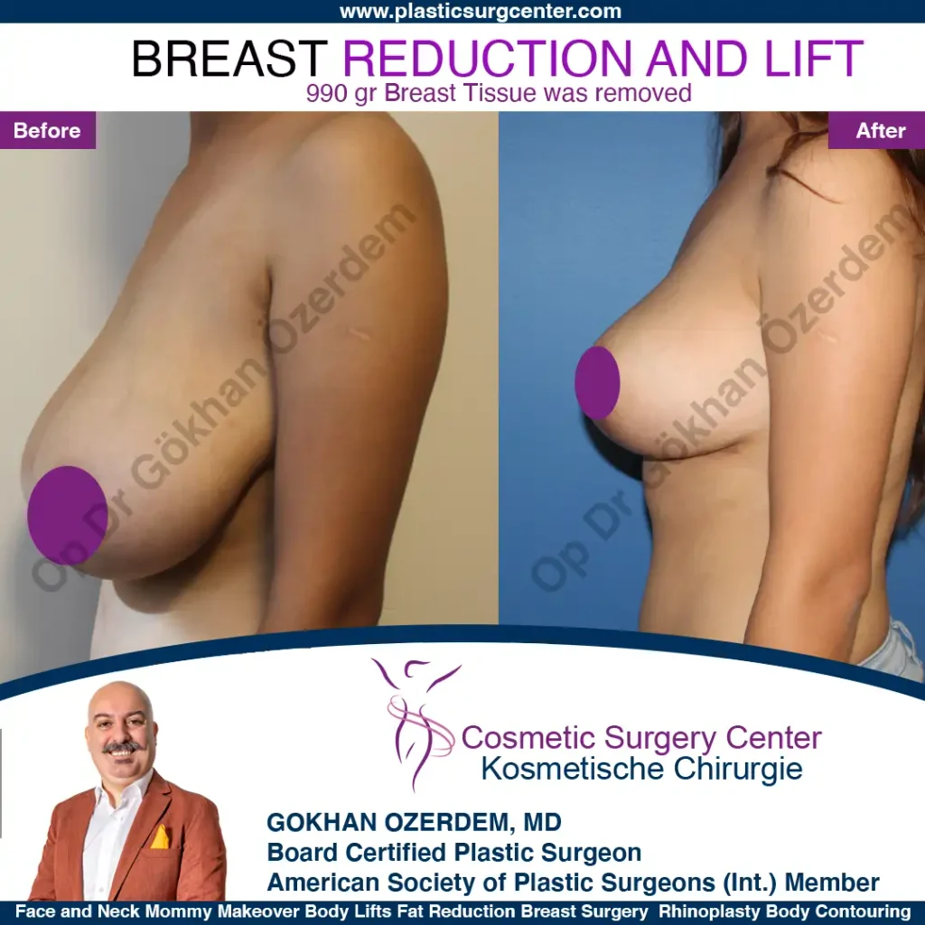 Breast Reduction in Turkey, Case 6 - Left Side