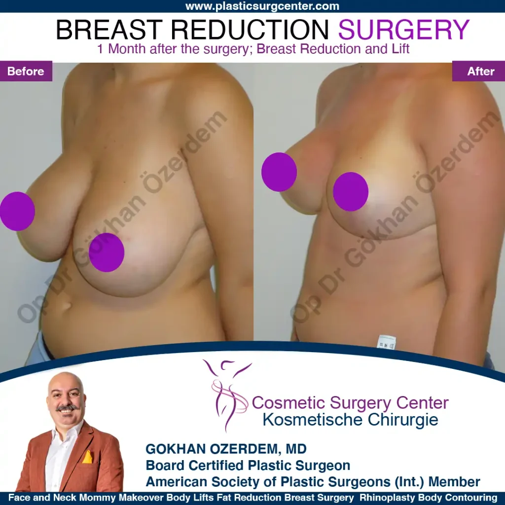 Breast Reduction in Turkey, Case 10 - Oblique View