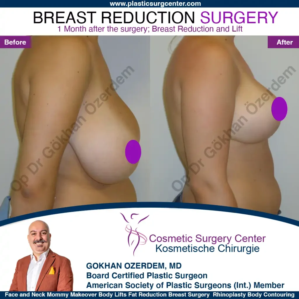 Breast Reduction in Turkey, Case 10 - Right Side