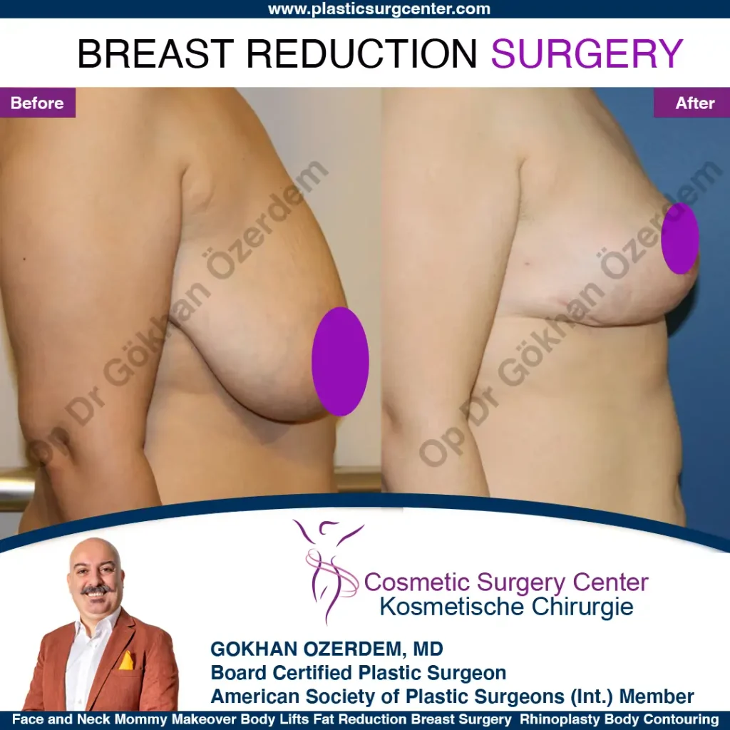 Breast Reduction in Turkey, Case 9 - Right Side