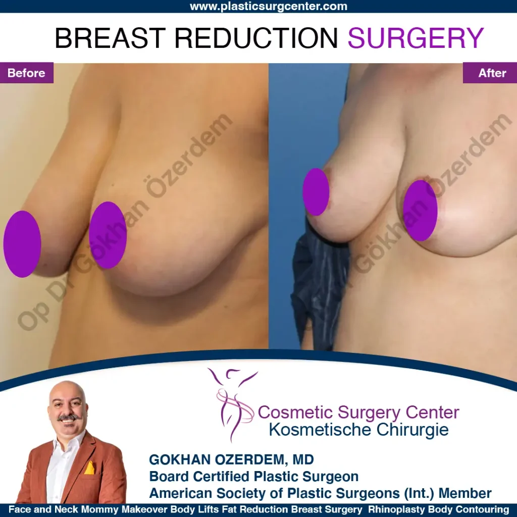 Breast Reduction in Turkey, Case 9 - Oblique View
