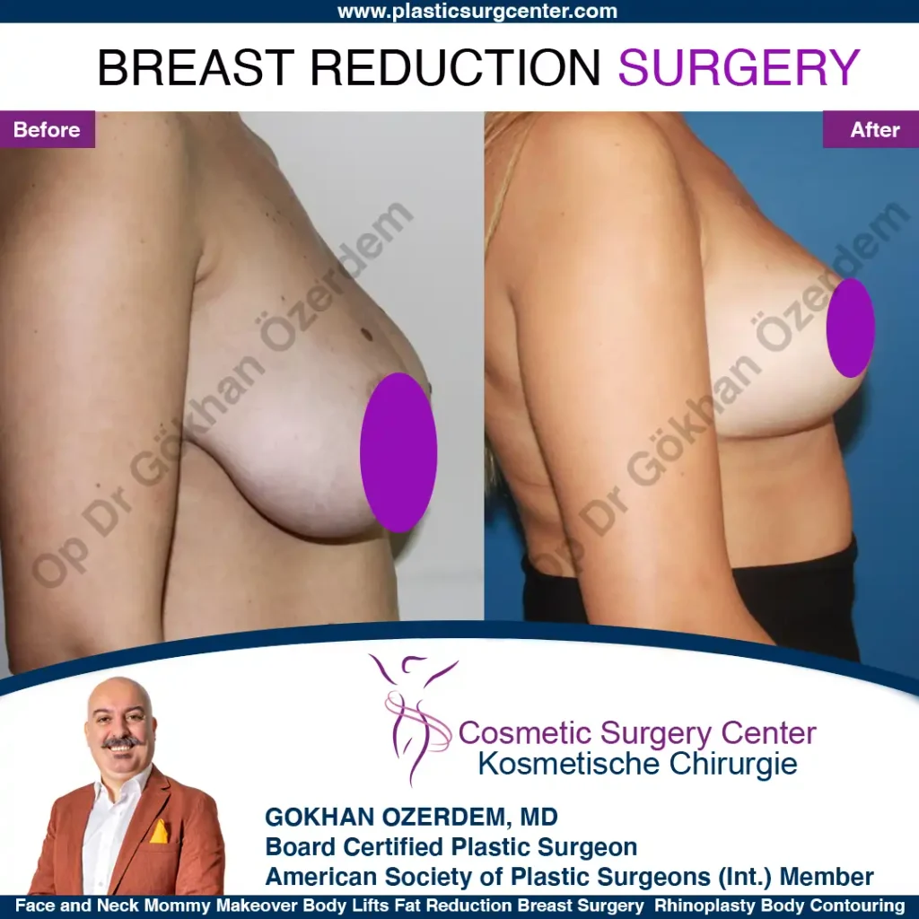 Breast Reduction in Turkey, Case 8 - Right Side