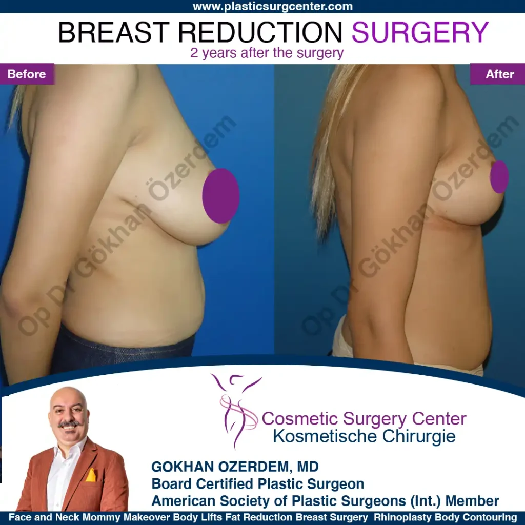 Breast Reduction in Turkey, Case 5 - Right Side
