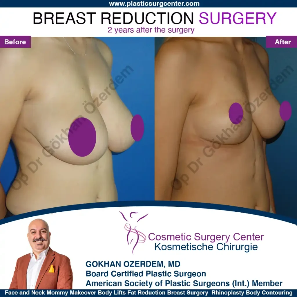 Breast Reduction in Turkey, Case 5 - Oblique View