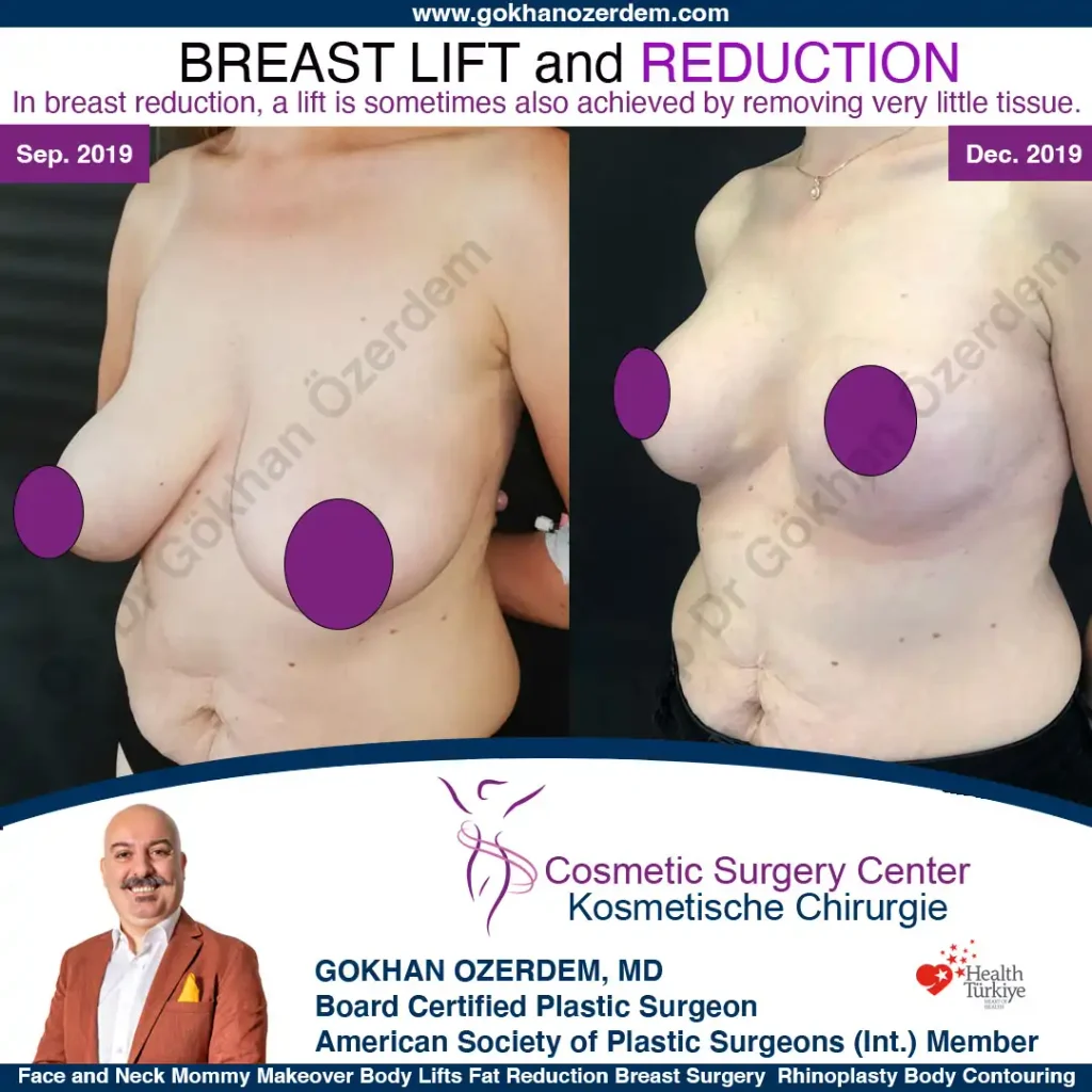 Breast Reduction in Turkey, Case 4 - Oblique View
