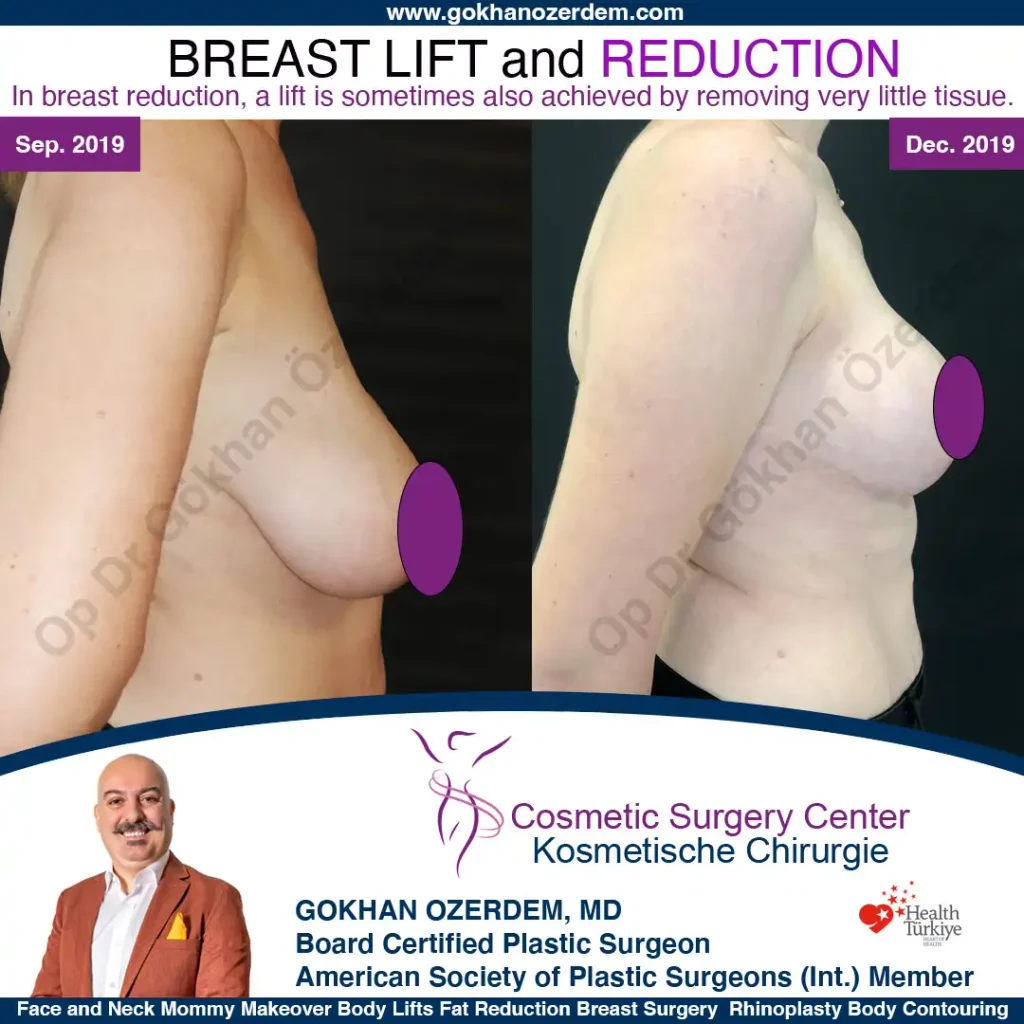 Breast Reduction in Turkey, Case 4 - Right Side