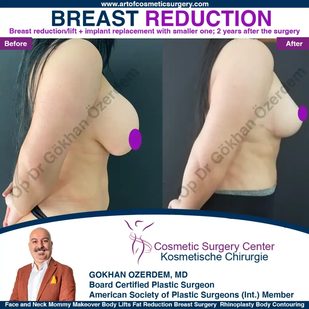 Breast Reduction in Turkey, Case 3 - Right Side