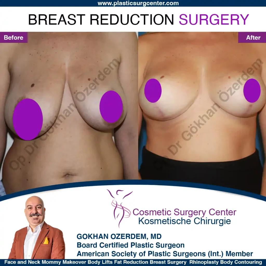 Breast Reduction in Turkey, Case 8 - Front View
