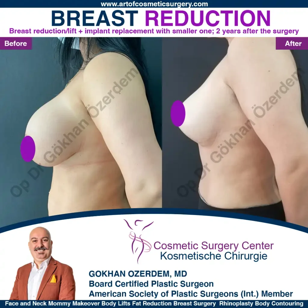 Breast Reduction in Turkey, Case 3 - Left Side