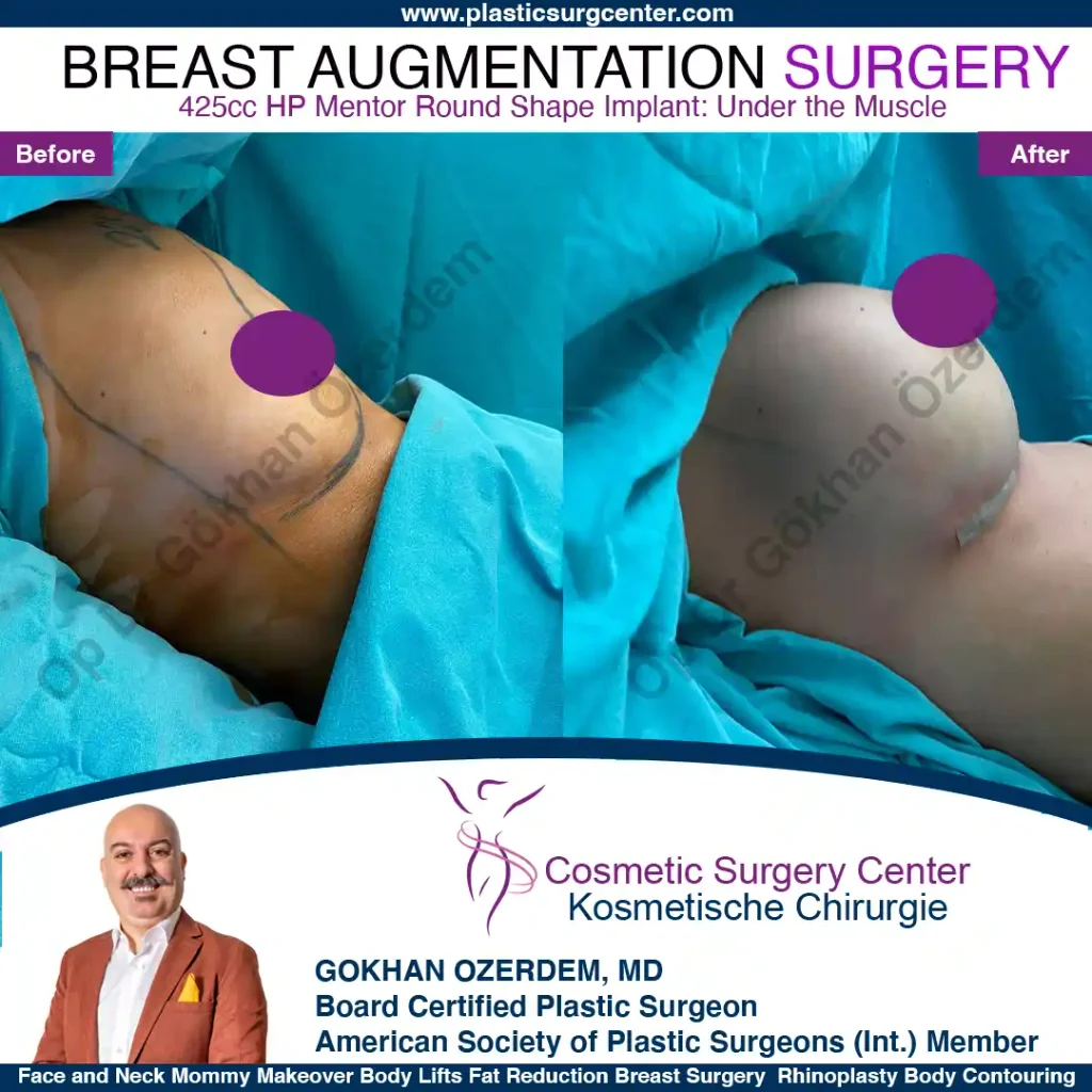 Breast Augmentation in Turkey - Case 17 - Right Side