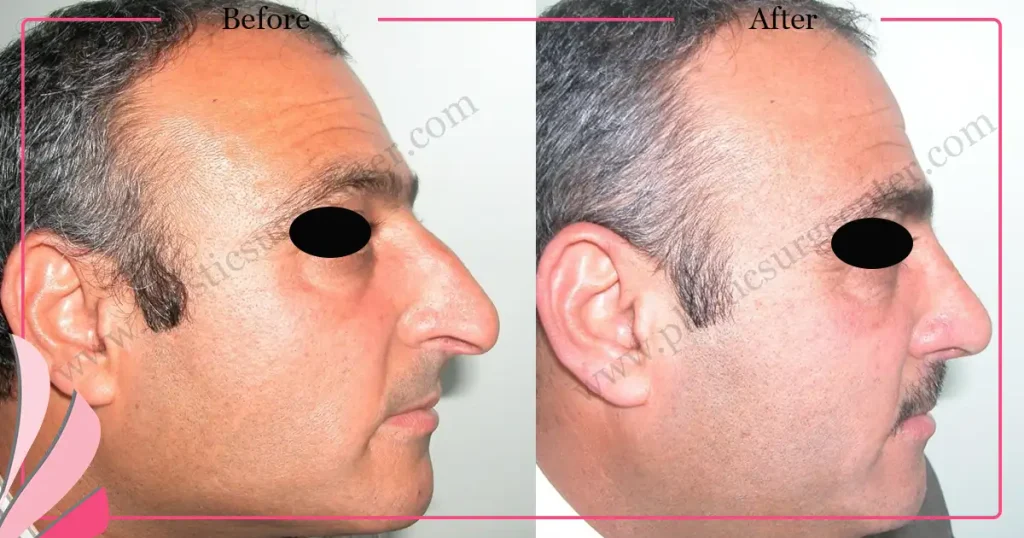 Rhinoplasty in Turkey - Case 26 - Male - Right Profile