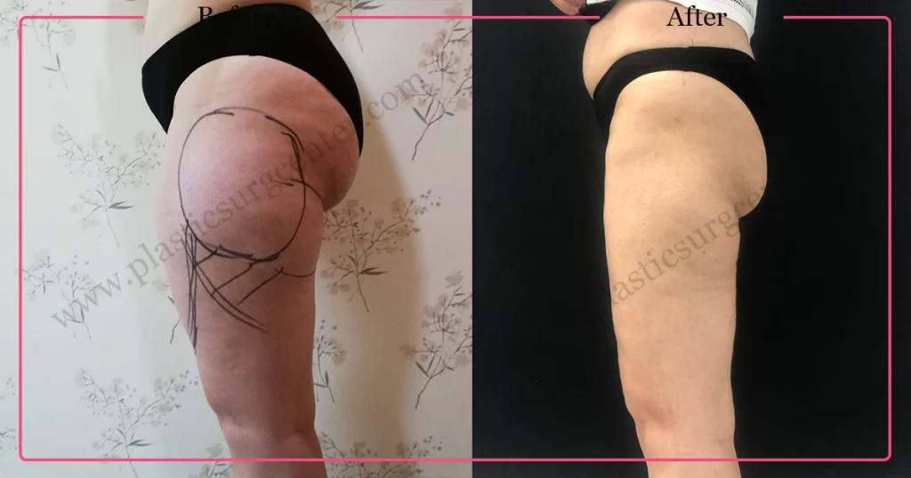 Leg Liposuction in Turkey - Case 3 - Left
