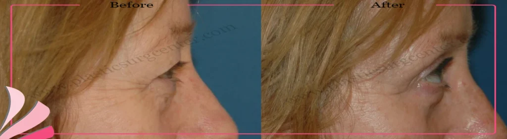 Upper eyelid surgery - case 24 - Right profile