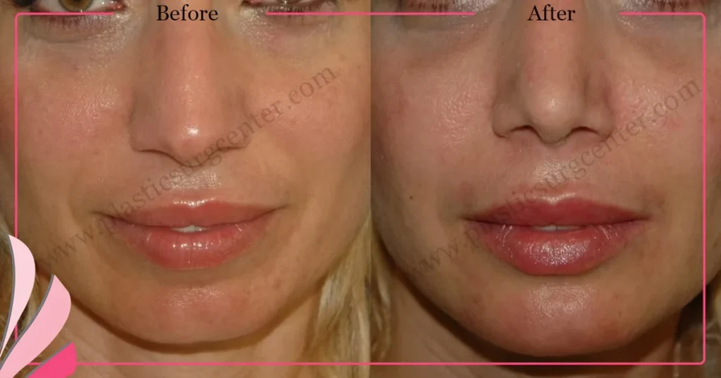 Chin augmentation, implant - Mentoplasty - Case 7 - Front View