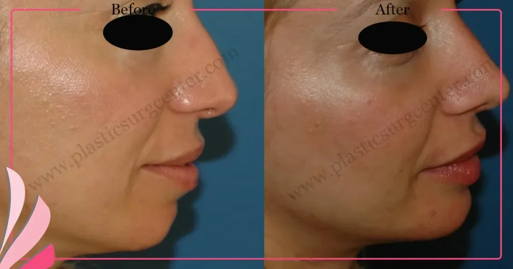Chin augmentation, implant - Mentoplasty - Case 7 - Right Profile