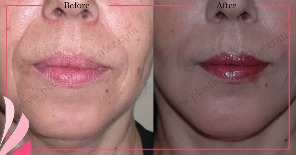 Chin augmentation, implant - Mentoplasty - Case 6 - Front View
