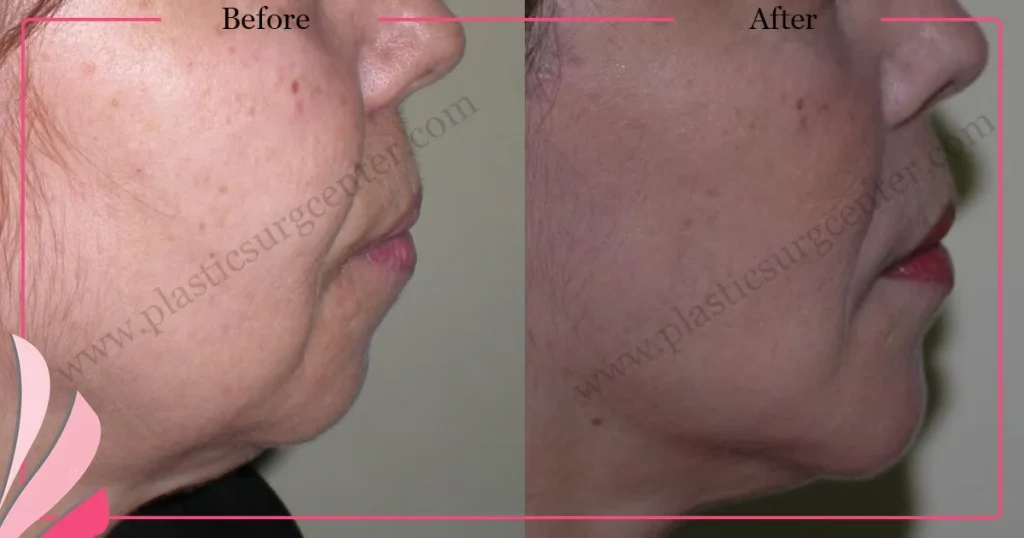 Chin augmentation, implant - Mentoplasty - Case 6 - Right Profile