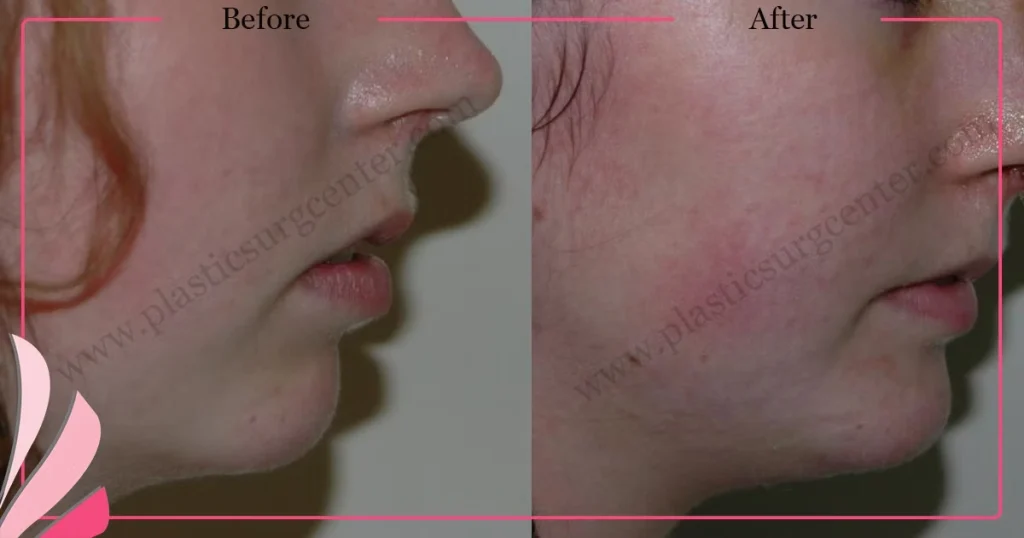 Chin augmentation, implant - Mentoplasty - Case 5 - Right Profile