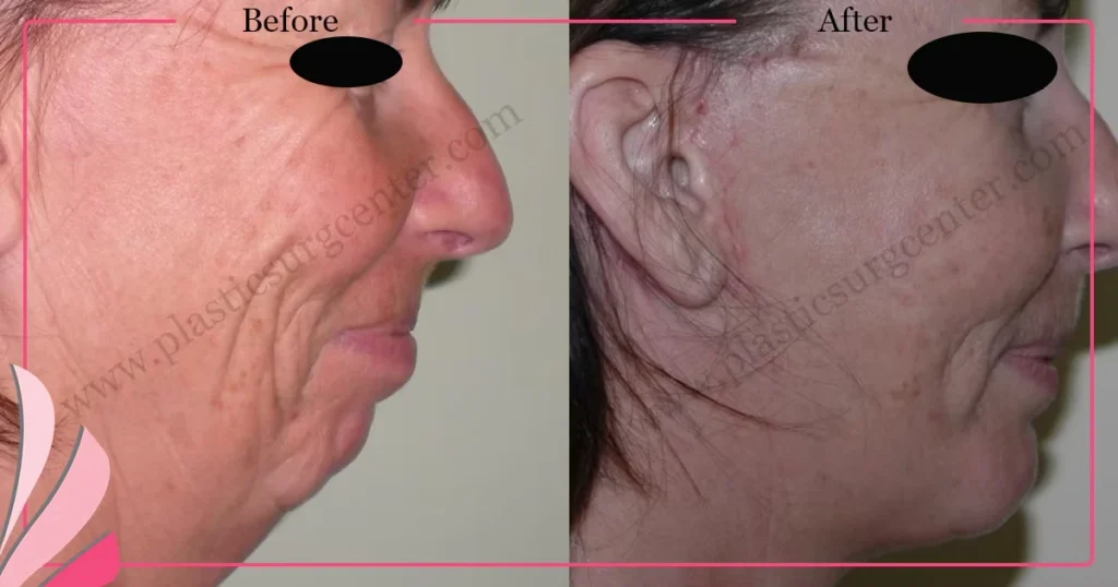 Chin augmentation, implant - Mentoplasty - Case 4 - Right Profile