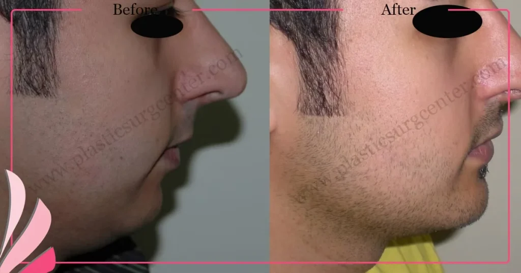Chin augmentation, implant - Mentoplasty - Case 3 - Right Profile