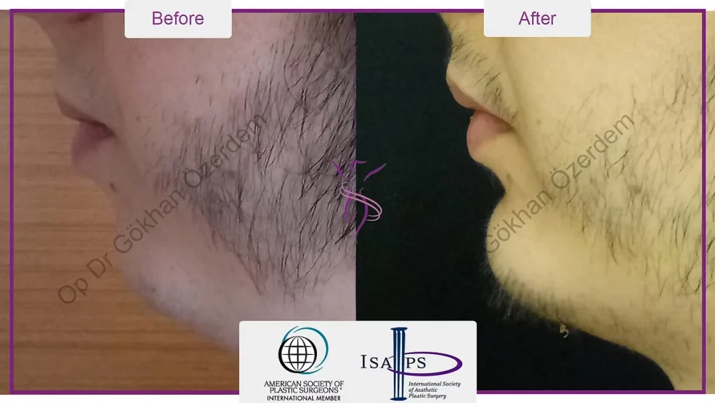 Chin augmentation, implant - Mentoplasty - Case 2 - Left Profile