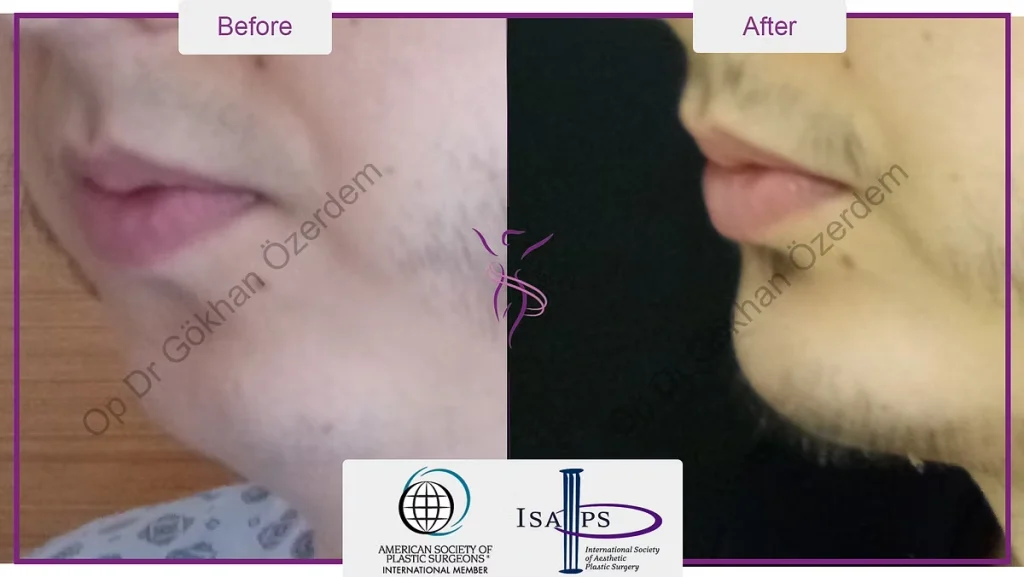 Chin augmentation, implant - Mentoplasty - Case 2 - Obilique View