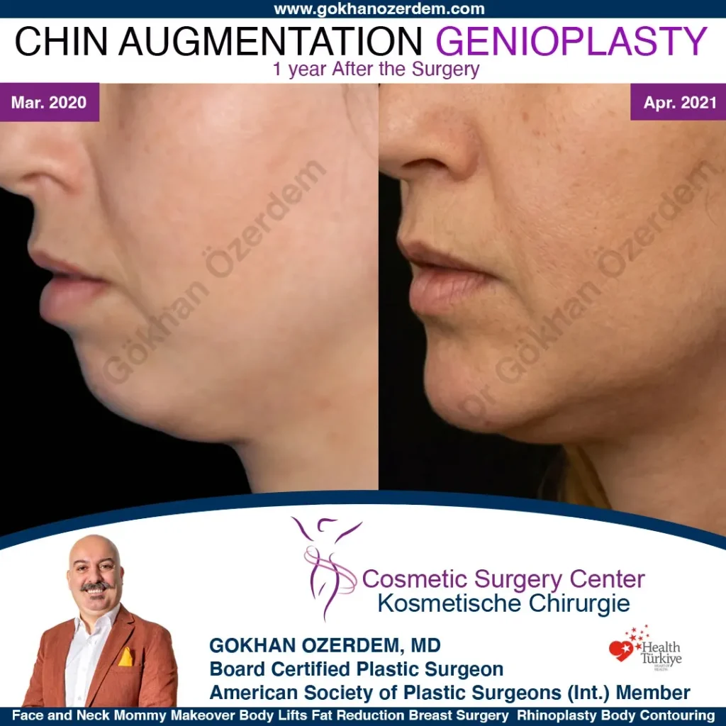 Chin augmentation, implant - Mentoplasty - Case 1 - Obilique View