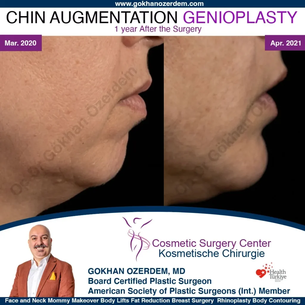 Chin augmentation, implant - Case 1 - Right Profile
