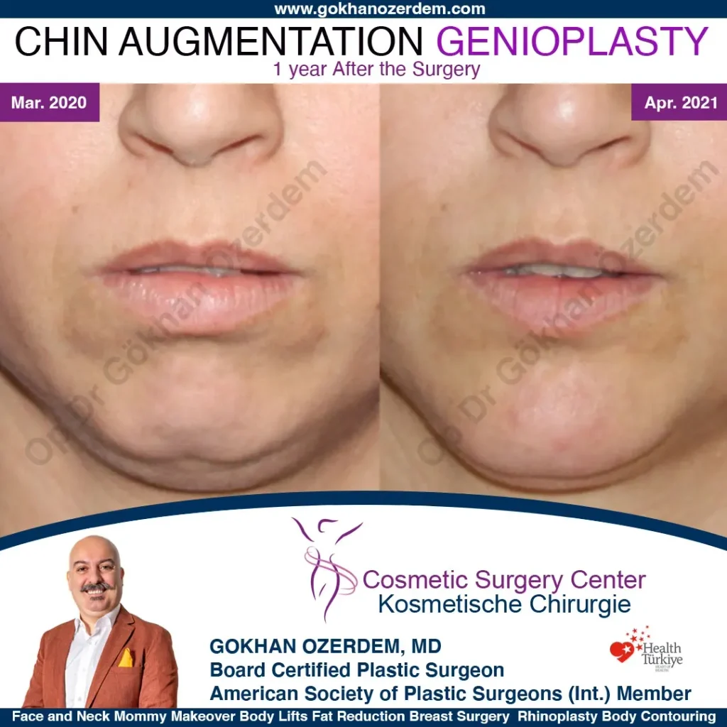 Chin augmentation, implant - Mentoplasty - Case 1 - Front View