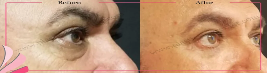 Lower eyelid surgery - case 23 - Right Oblique