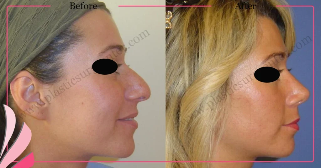 Rhinoplasty in Turkey - Case 24 - Female - Right Profile