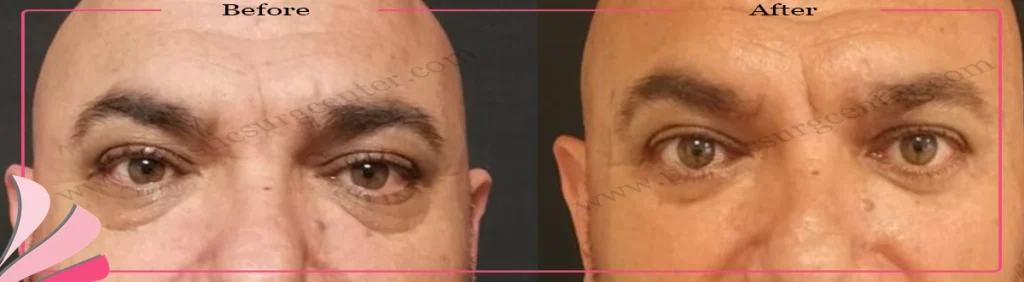 Lower eyelid surgery - case 23 - Front view