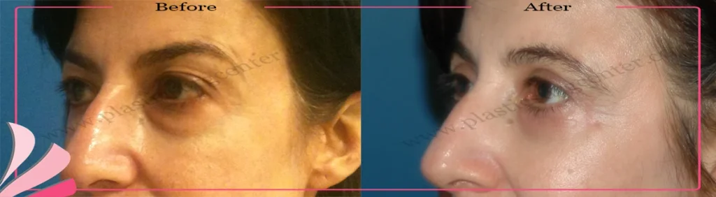 Lower eyelid surgery - case 22 - Left Oblique