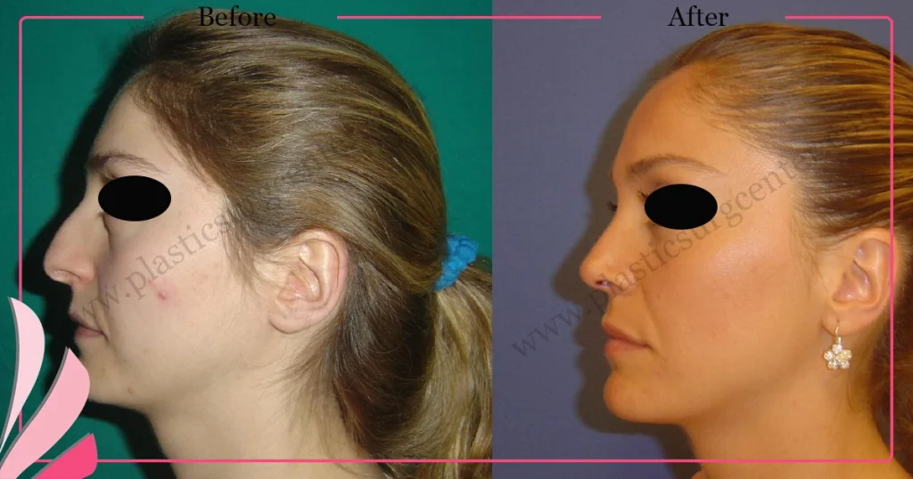 Rhinoplasty in Turkey - Case 25 - Female - Left Profile