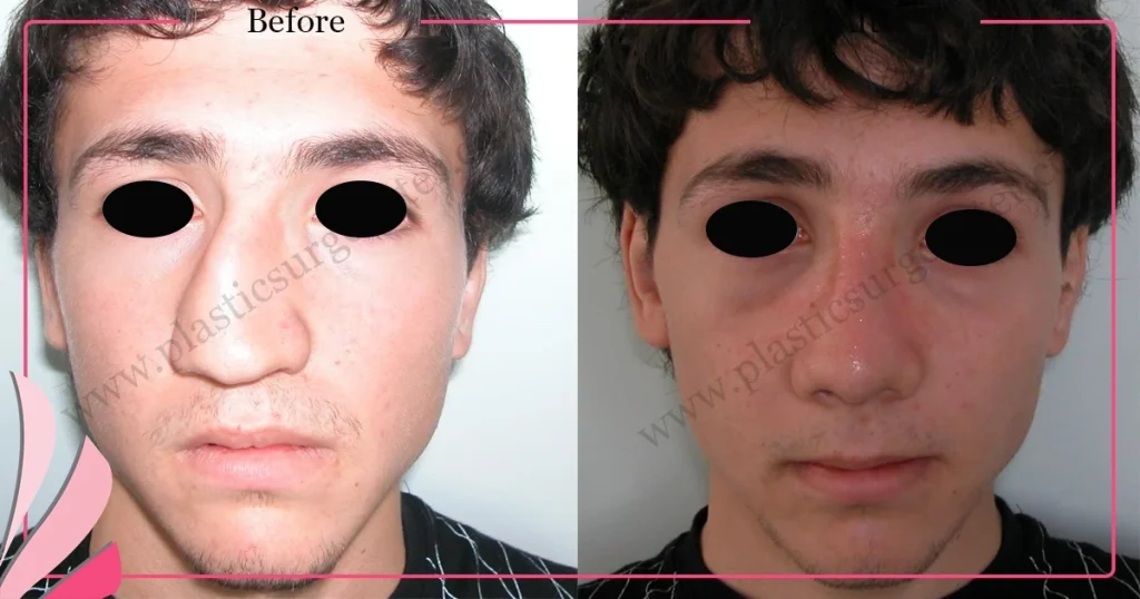 Rhinoplasty in Turkey - Case 21 - Male - Front view
