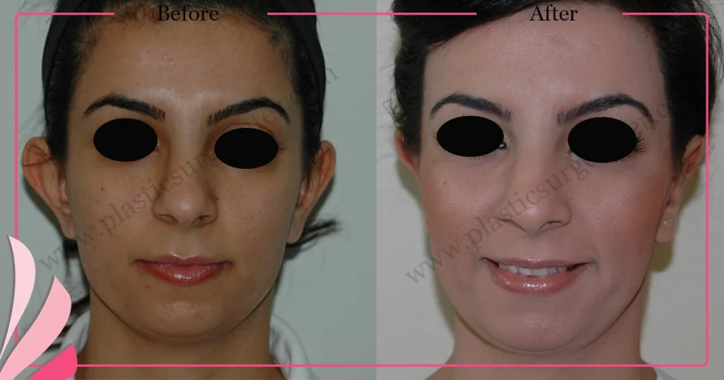 Otoplasty, Prominent ear surgery - Case 6 - Front View
