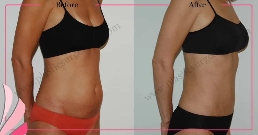 Abdominal liposuction in turkey - Case 5 - Right Oblique View